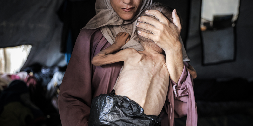 Muhammad Zakariya Ayyoub al-Matouq, a toddler in Gaza City, Gaza, faces life-threatening malnutrition as the humanitarian situation worsens due to ongoing Israeli attacks and blockade, on July 21, 2025. (Photo by Ahmed Jihad Ibrahim Al-arini/Anadolu via Getty Images)