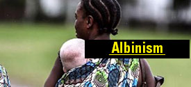 albinism